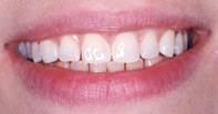 New York City dental implants will give you a smile to remember