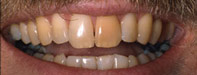 Discoloration and large gaps between teeth before New York City dental implants