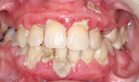 Almost any dental problem can be fixed with New York City dental implants