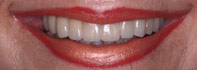 New York City dental implants can straighten out any smile