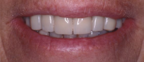 Teeth straightened by New York City dental implants