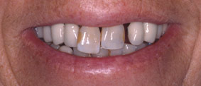 New York City dental implants save smiles